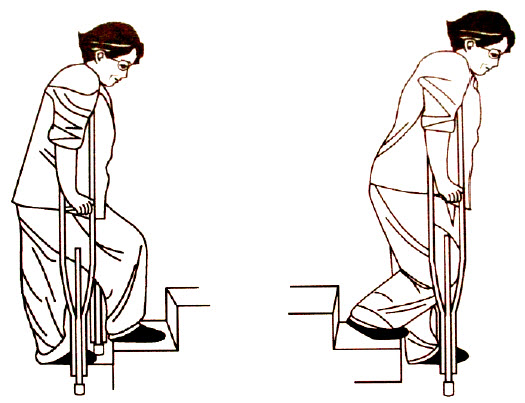 膝关节置换术后康复的锻炼及注意事项（一）