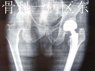 【典型案例】高龄患者股骨颈骨折的手术治疗
