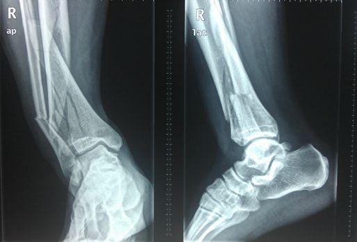 【典型案例】MIPO技术治疗粉碎性胫腓骨骨折