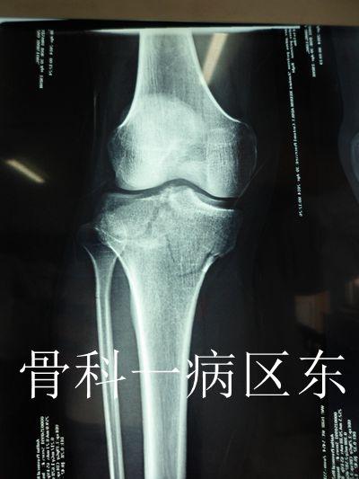 【典型案例】胫骨平台后柱骨折的手术治疗