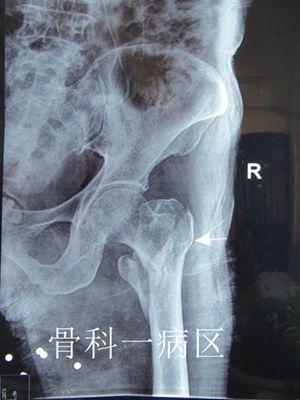 【典型案例】股骨粗隆间骨折的微创治疗