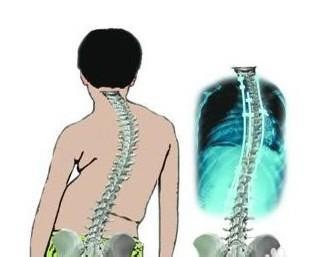青少年腰疼需警惕强直性脊柱炎