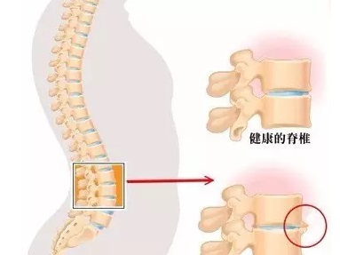 有趣五招应对腰椎骨质增生